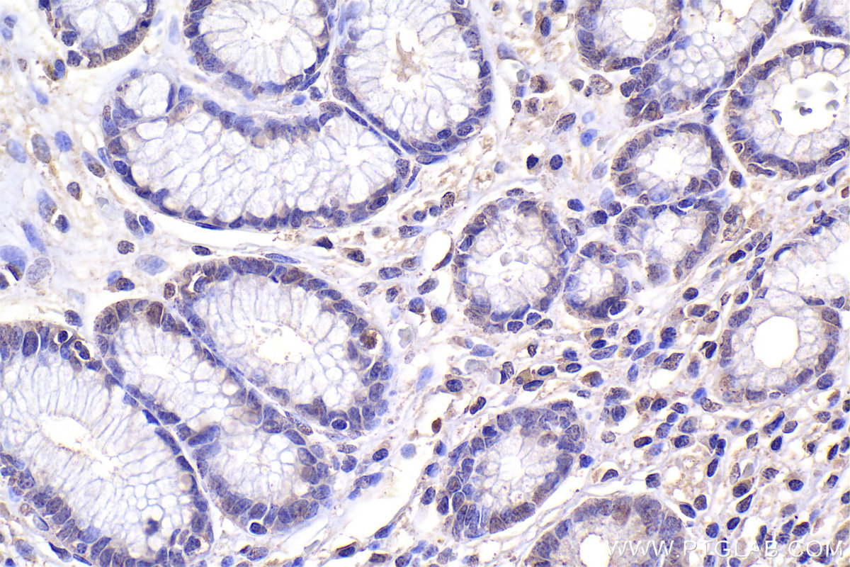 Immunohistochemistry (IHC) staining of human stomach cancer tissue using SMAD3 Monoclonal antibody (66516-1-Ig)