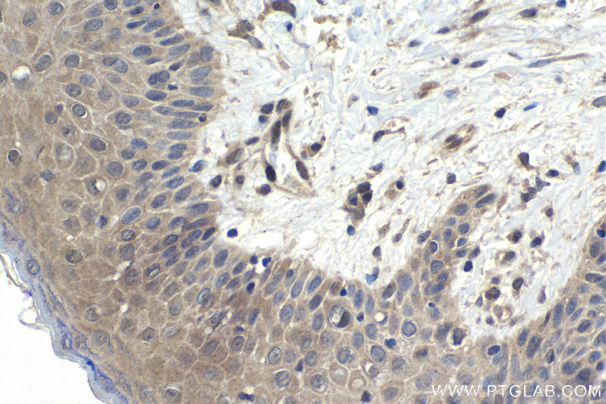 Immunohistochemistry (IHC) staining of human skin cancer tissue using SMAD4 Polyclonal antibody (10231-1-AP)