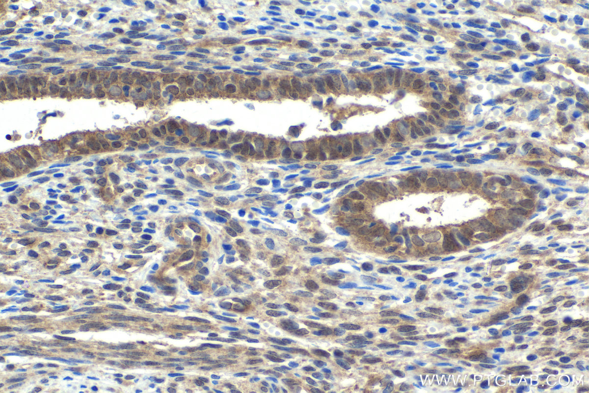 Immunohistochemistry (IHC) staining of human cervical cancer tissue using SMAD4 Polyclonal antibody (10231-1-AP)