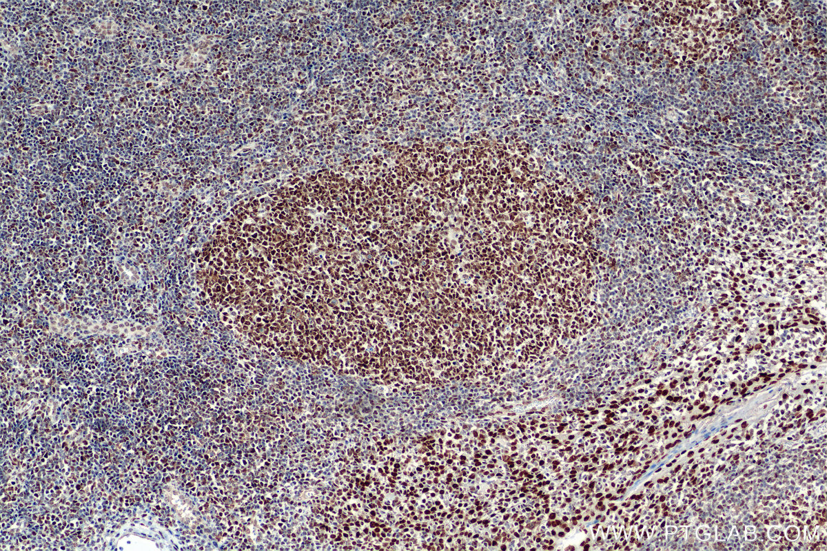 Immunohistochemistry (IHC) staining of human tonsillitis tissue using SMARCA4 Recombinant antibody (83310-2-RR)