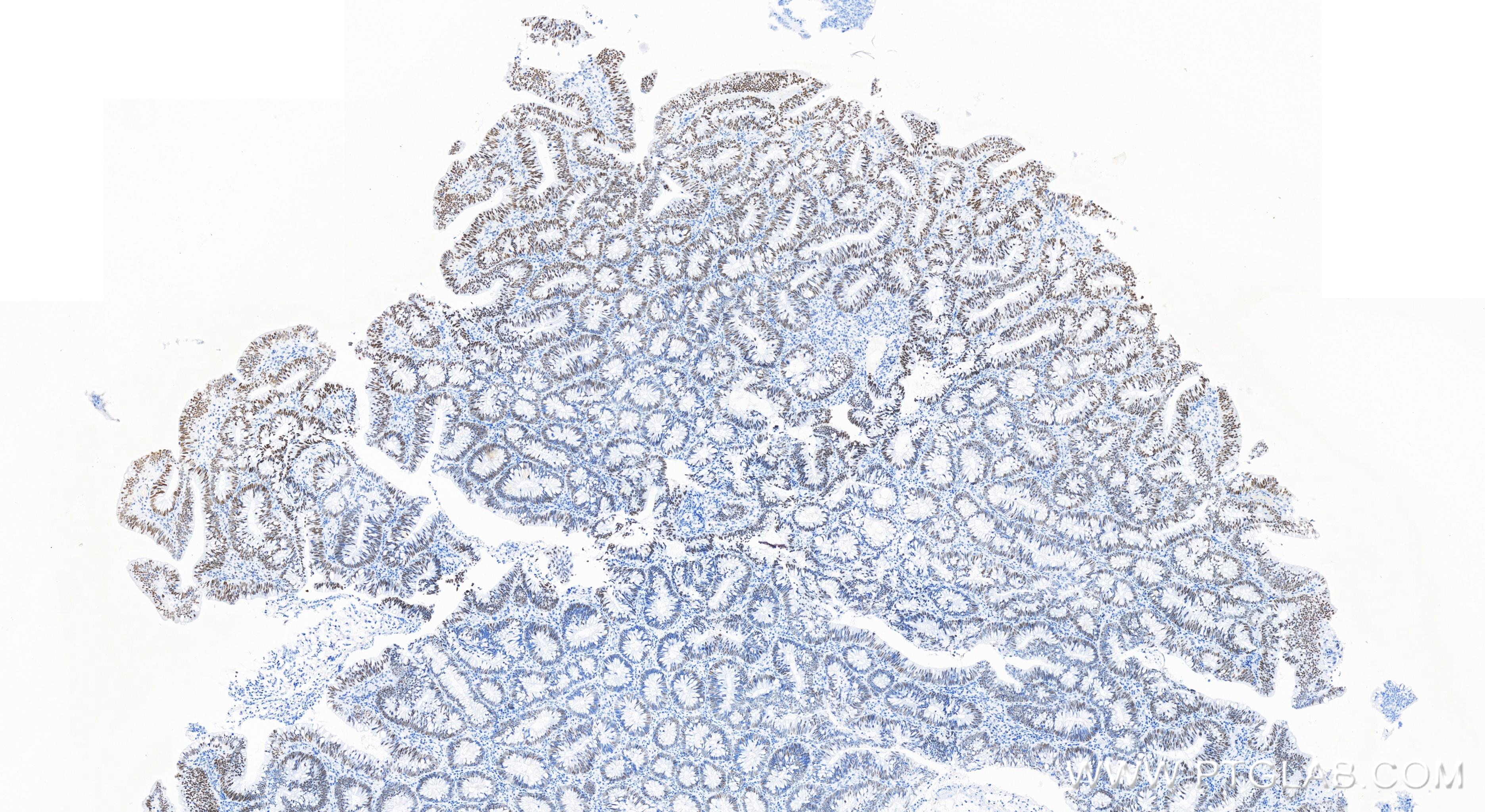 Immunohistochemistry (IHC) staining of human colon cancer tissue using SMARCA4 Recombinant antibody (83310-7-RR)