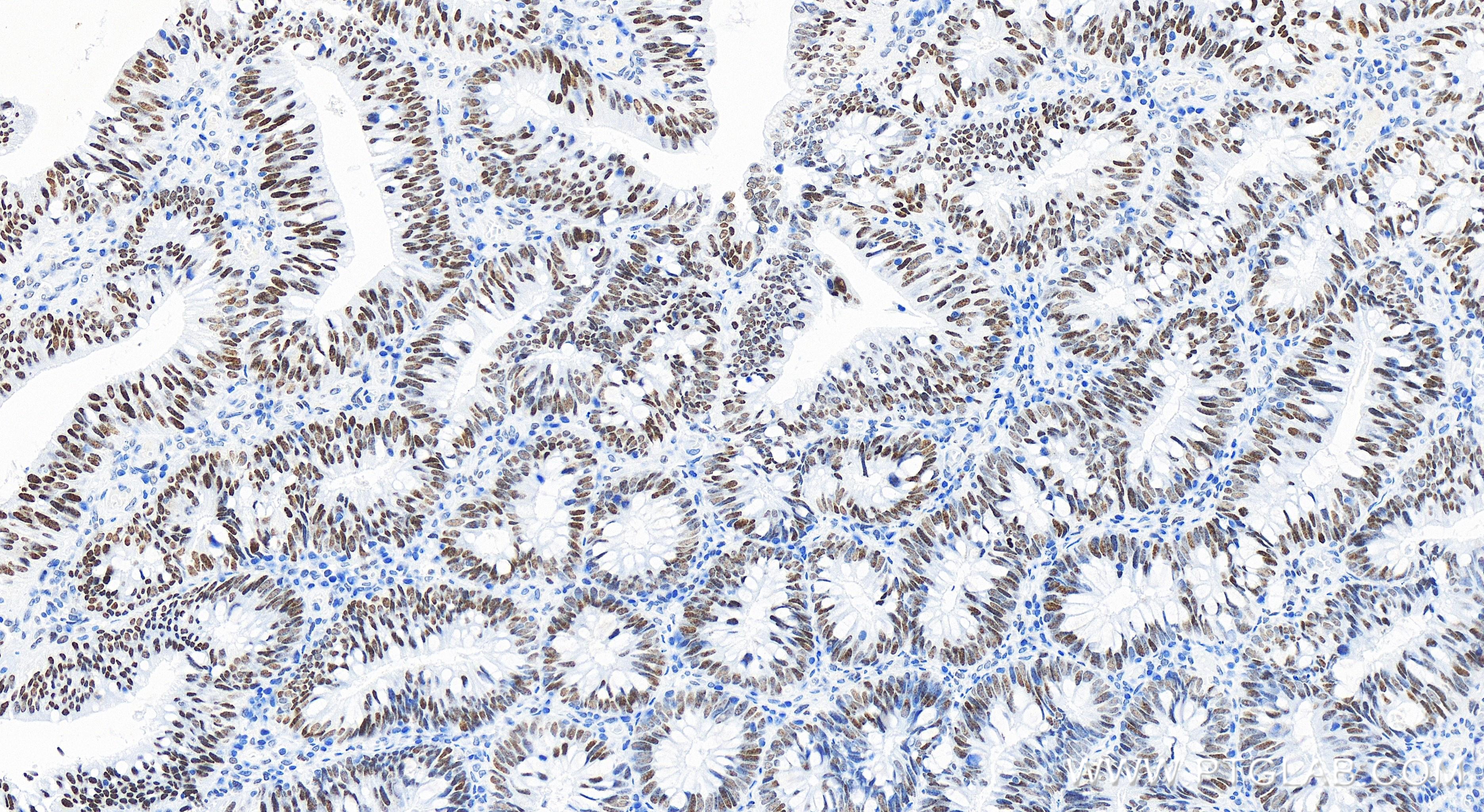 Immunohistochemistry (IHC) staining of human colon cancer tissue using SMARCA4 Recombinant antibody (83310-7-RR)