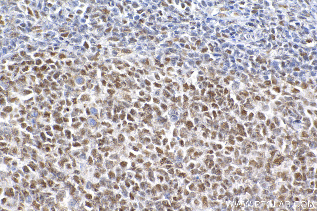 Immunohistochemistry (IHC) staining of human tonsillitis tissue using SMARCA4 Recombinant antibody (83310-7-RR)
