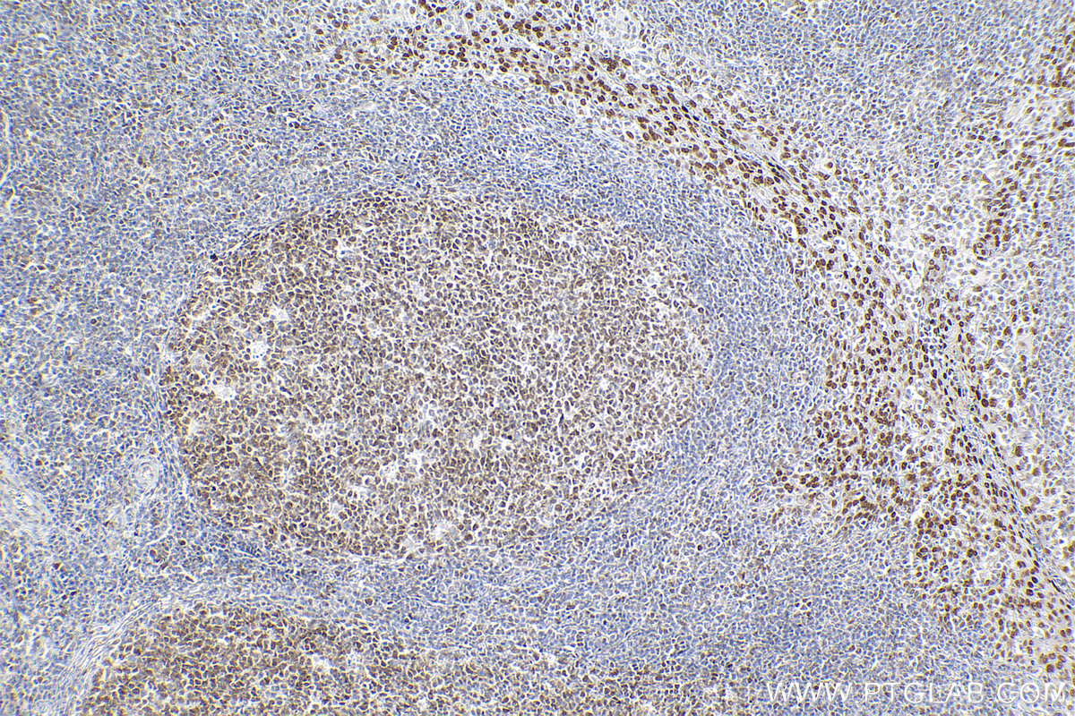 Immunohistochemistry (IHC) staining of human tonsillitis tissue using SMARCA4 Recombinant antibody (83310-7-RR)