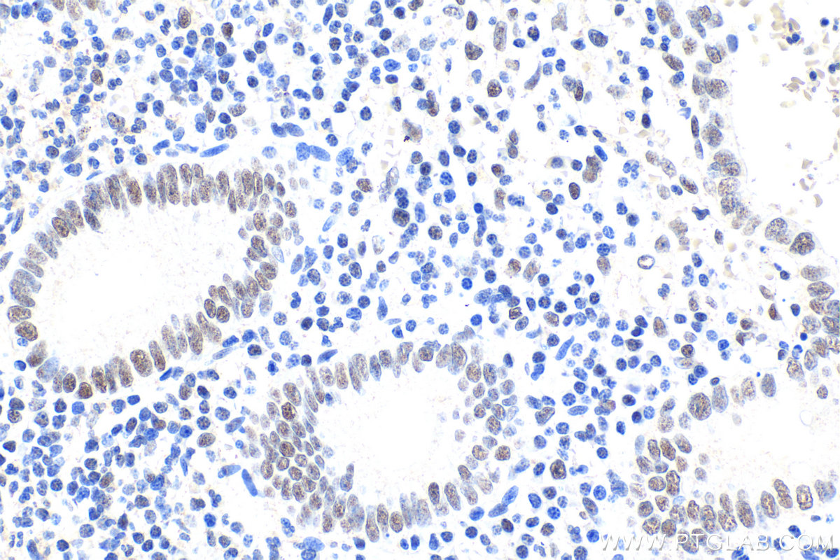 Immunohistochemistry (IHC) staining of human appendicitis tissue using SMARCC1 Polyclonal antibody (17722-1-AP)