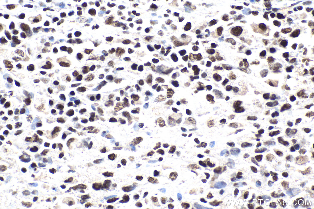 Immunohistochemistry (IHC) staining of human malignant melanoma tissue using SMARCC1 Polyclonal antibody (17722-1-AP)