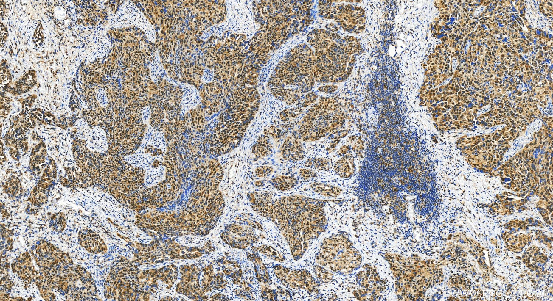 Immunohistochemistry (IHC) staining of human ovary cancer tissue using SMC2 Polyclonal antibody (30707-1-AP)