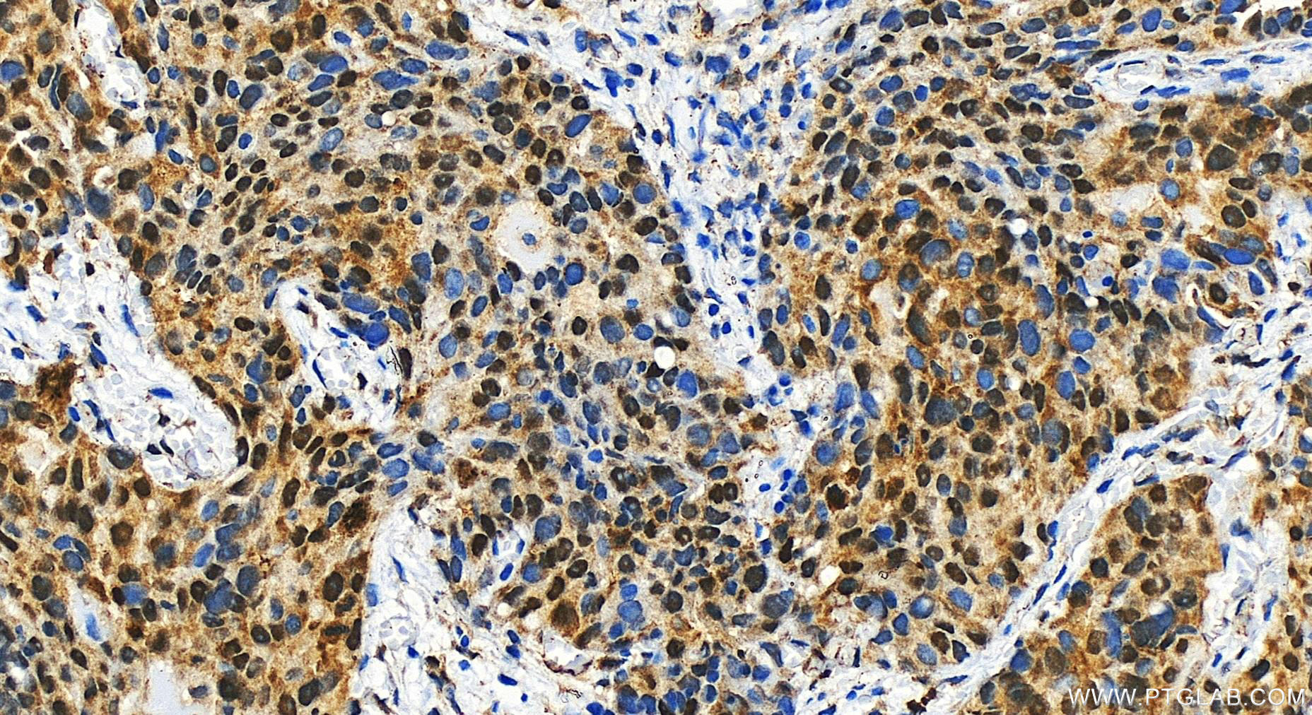 Immunohistochemistry (IHC) staining of human ovary cancer tissue using SMC2 Polyclonal antibody (30707-1-AP)