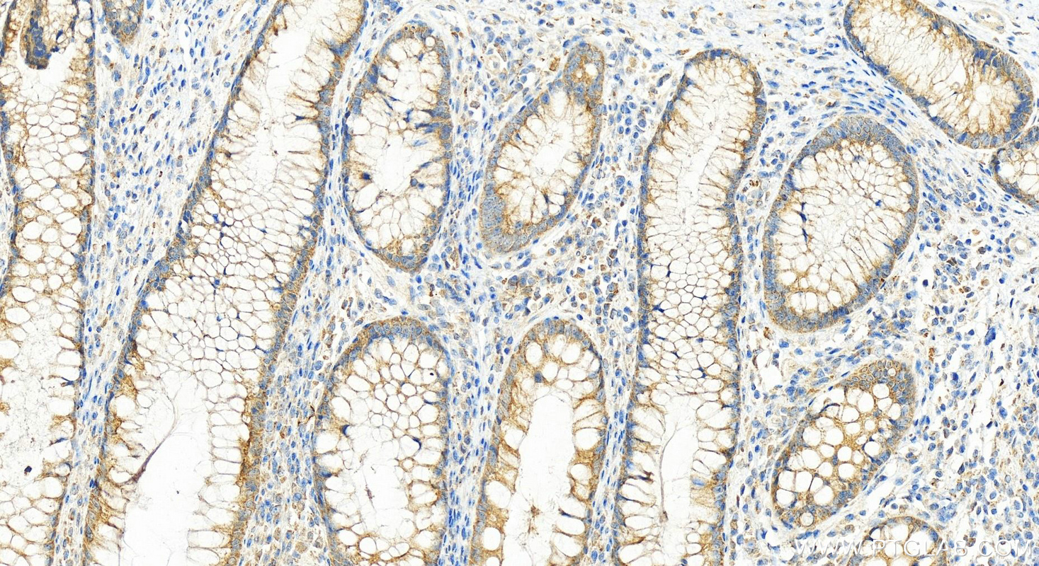 Immunohistochemistry (IHC) staining of human colon cancer tissue using SMCO4 Polyclonal antibody (25815-1-AP)