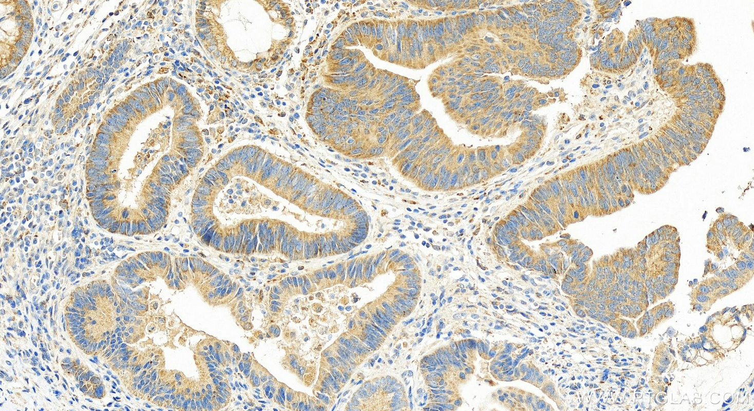 Immunohistochemistry (IHC) staining of human colon cancer tissue using SMCO4 Polyclonal antibody (25815-1-AP)