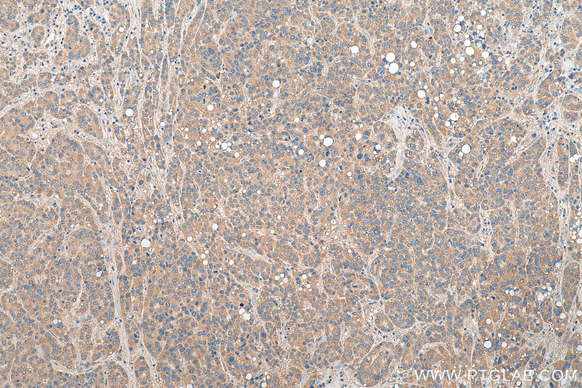 Immunohistochemistry (IHC) staining of human liver cancer tissue using SMCR7/MID49 Polyclonal antibody (28718-1-AP)