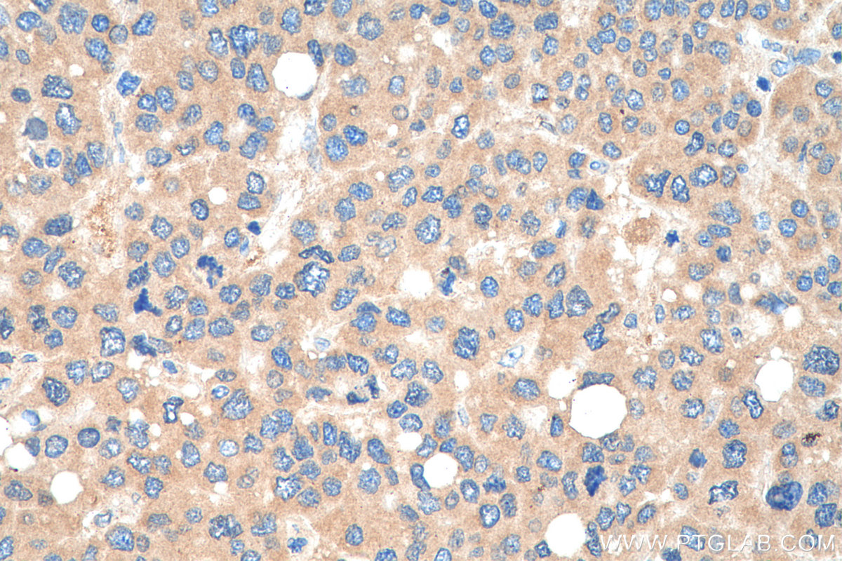 Immunohistochemistry (IHC) staining of human liver cancer tissue using SMCR7/MID49 Polyclonal antibody (28718-1-AP)