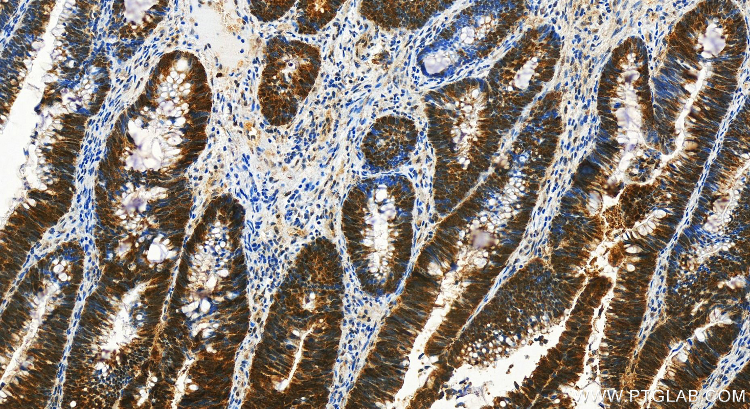 Immunohistochemistry (IHC) staining of human colon  cancer using SMN (Human-Specific) Monoclonal antibody (60154-1-Ig)