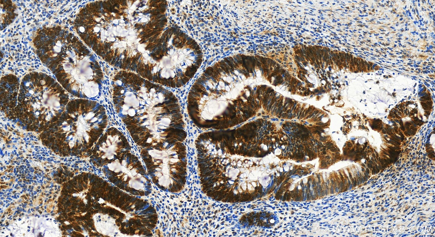 Immunohistochemistry (IHC) staining of human colon  cancer using SMN (Human-Specific) Monoclonal antibody (60154-1-Ig)