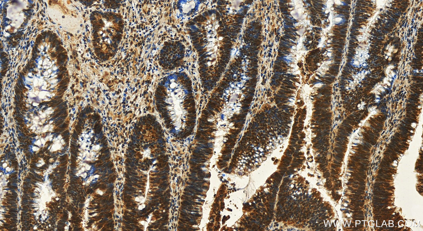 Immunohistochemistry (IHC) staining of human colon  cancer using SMN (Human,Mouse,Rat) Monoclonal antibody (60154-2-Ig)