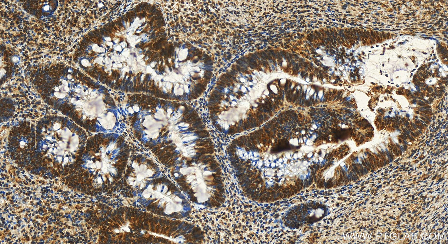 Immunohistochemistry (IHC) staining of human colon  cancer using SMN (Human,Mouse,Rat) Monoclonal antibody (60154-2-Ig)