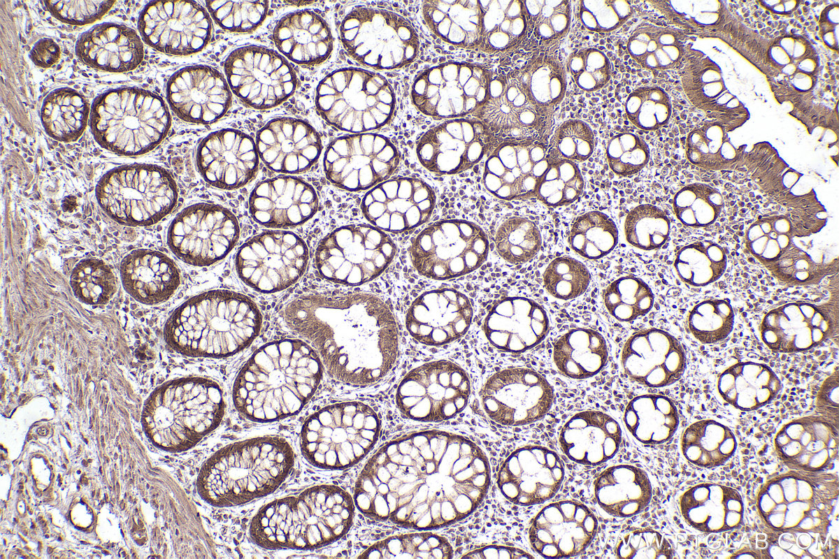 Immunohistochemistry (IHC) staining of human rectal cancer tissue using SMN (Human,Mouse,Rat) Monoclonal antibody (60154-2-Ig)