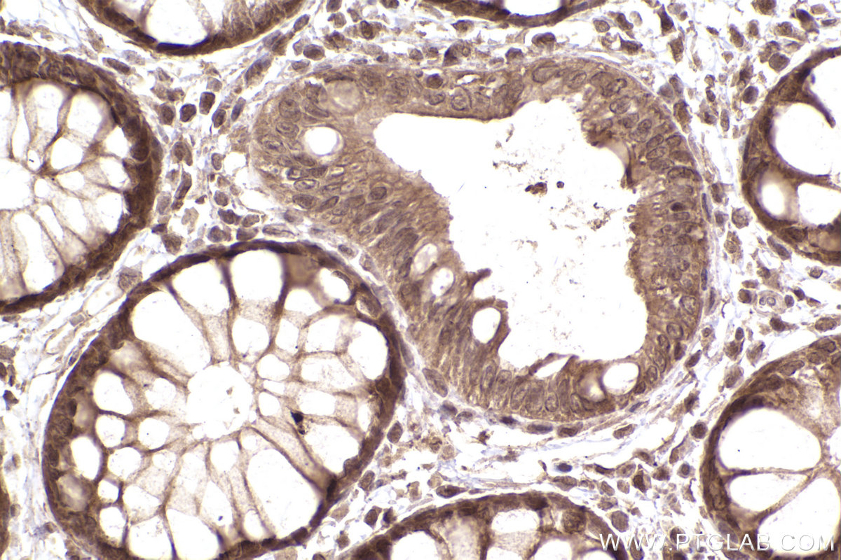 Immunohistochemistry (IHC) staining of human rectal cancer tissue using SMN (Human,Mouse,Rat) Monoclonal antibody (60154-2-Ig)