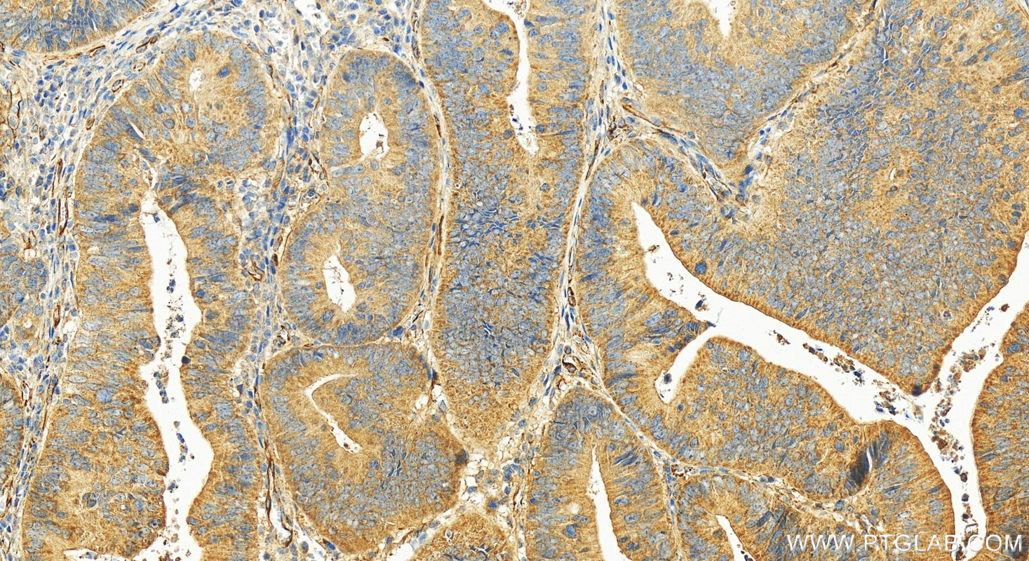 Immunohistochemistry (IHC) staining of human colon cancer tissue using SMYD3 Polyclonal antibody (12011-1-AP)