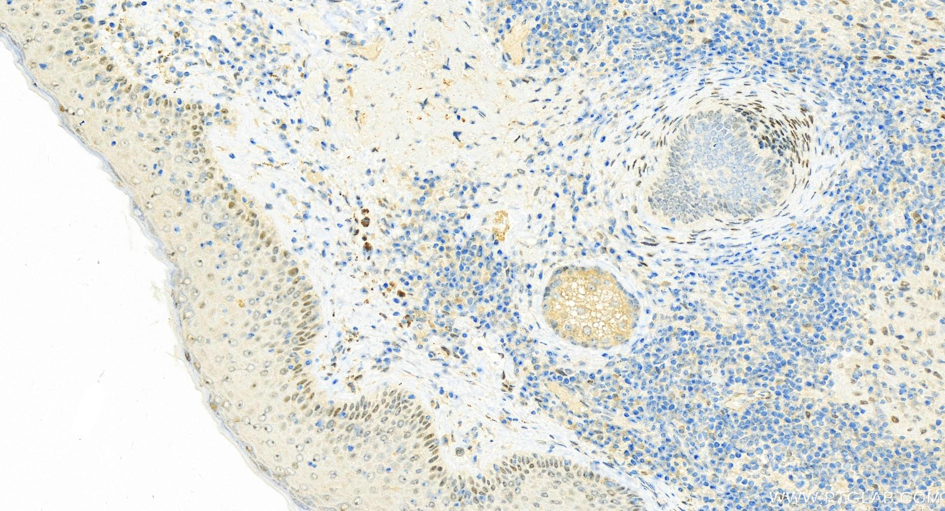 Immunohistochemistry (IHC) staining of human skin cancer tissue using SNAI2/SLUG Polyclonal antibody (12129-1-AP)