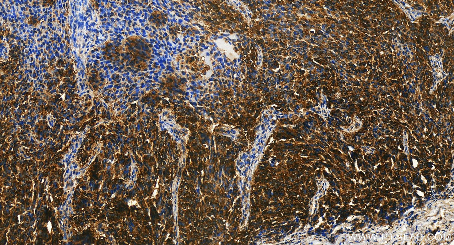 Immunohistochemistry (IHC) staining of human ovary cancer tissue using SNX24 Polyclonal antibody (16799-1-AP)