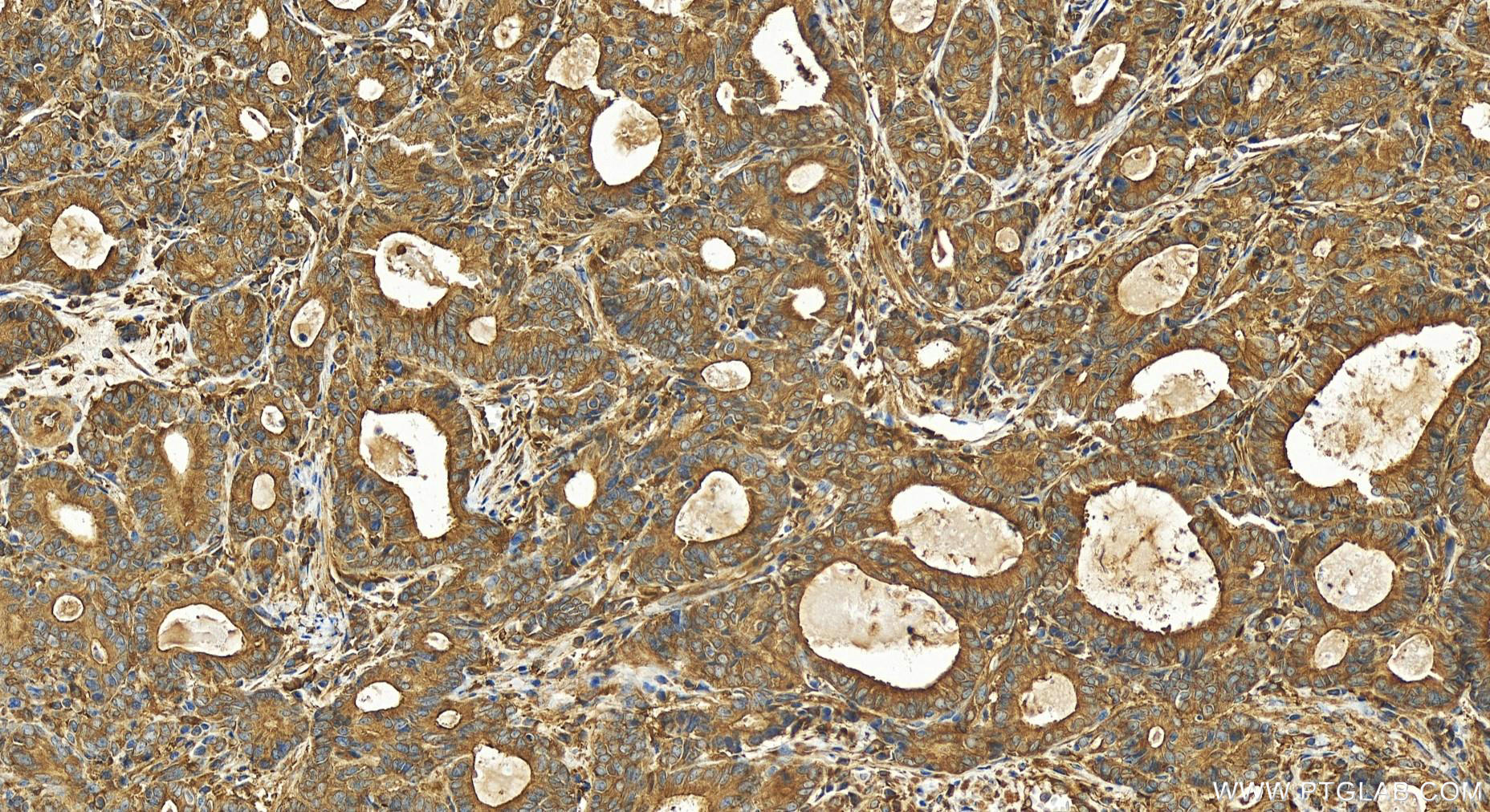 Immunohistochemistry (IHC) staining of human stomach cancer tissue using SNX9 Polyclonal antibody (15721-1-AP)