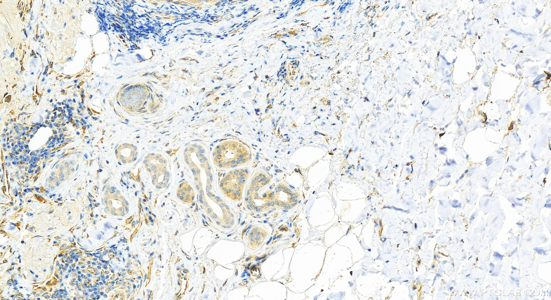 Immunohistochemistry (IHC) staining of human skin cancer tissue using SOCS3 Polyclonal antibody (14025-1-AP)