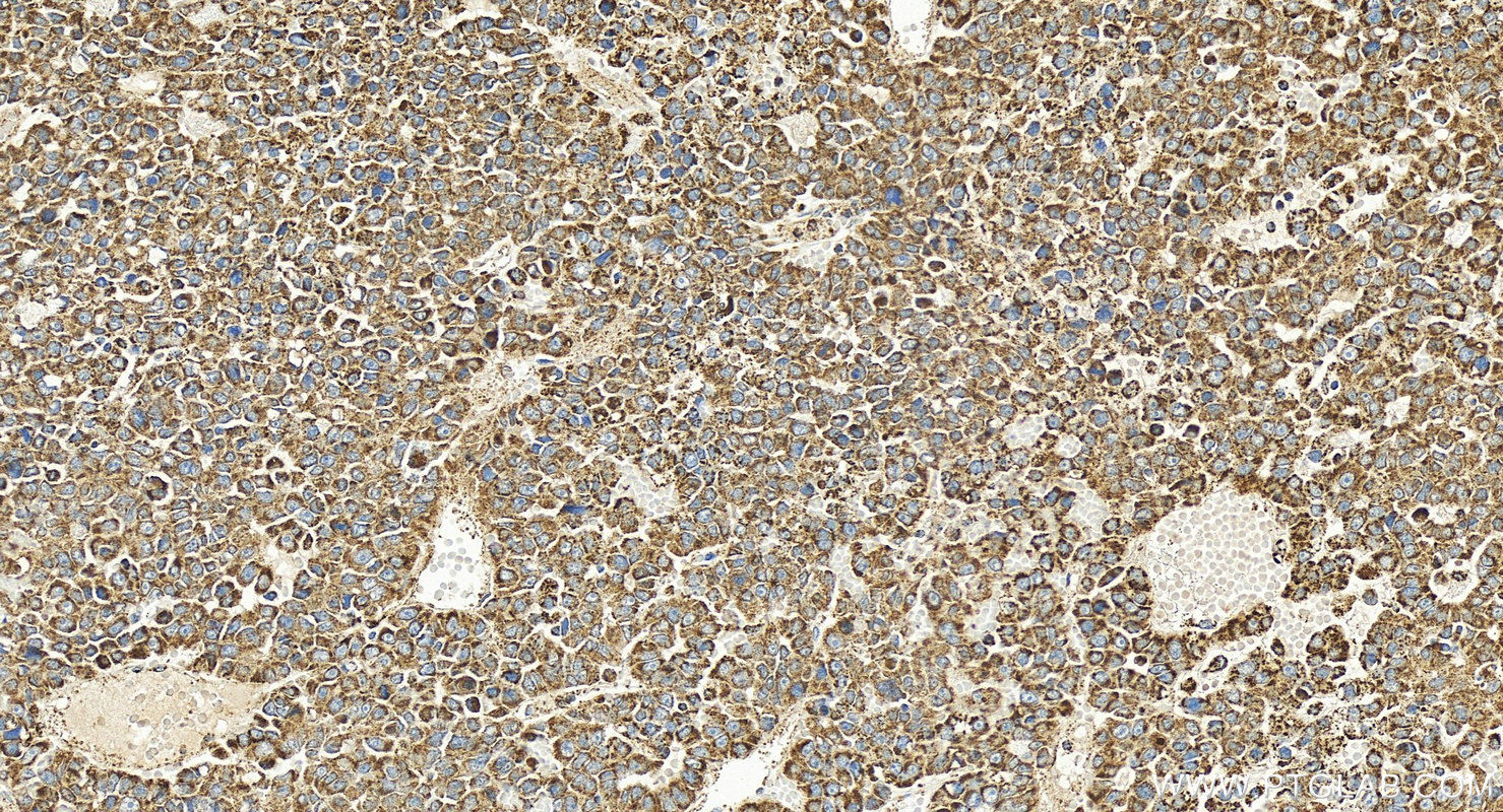 Immunohistochemistry (IHC) staining of human hepatocellular carcinoma using SOD2 Polyclonal antibody (24127-1-AP)