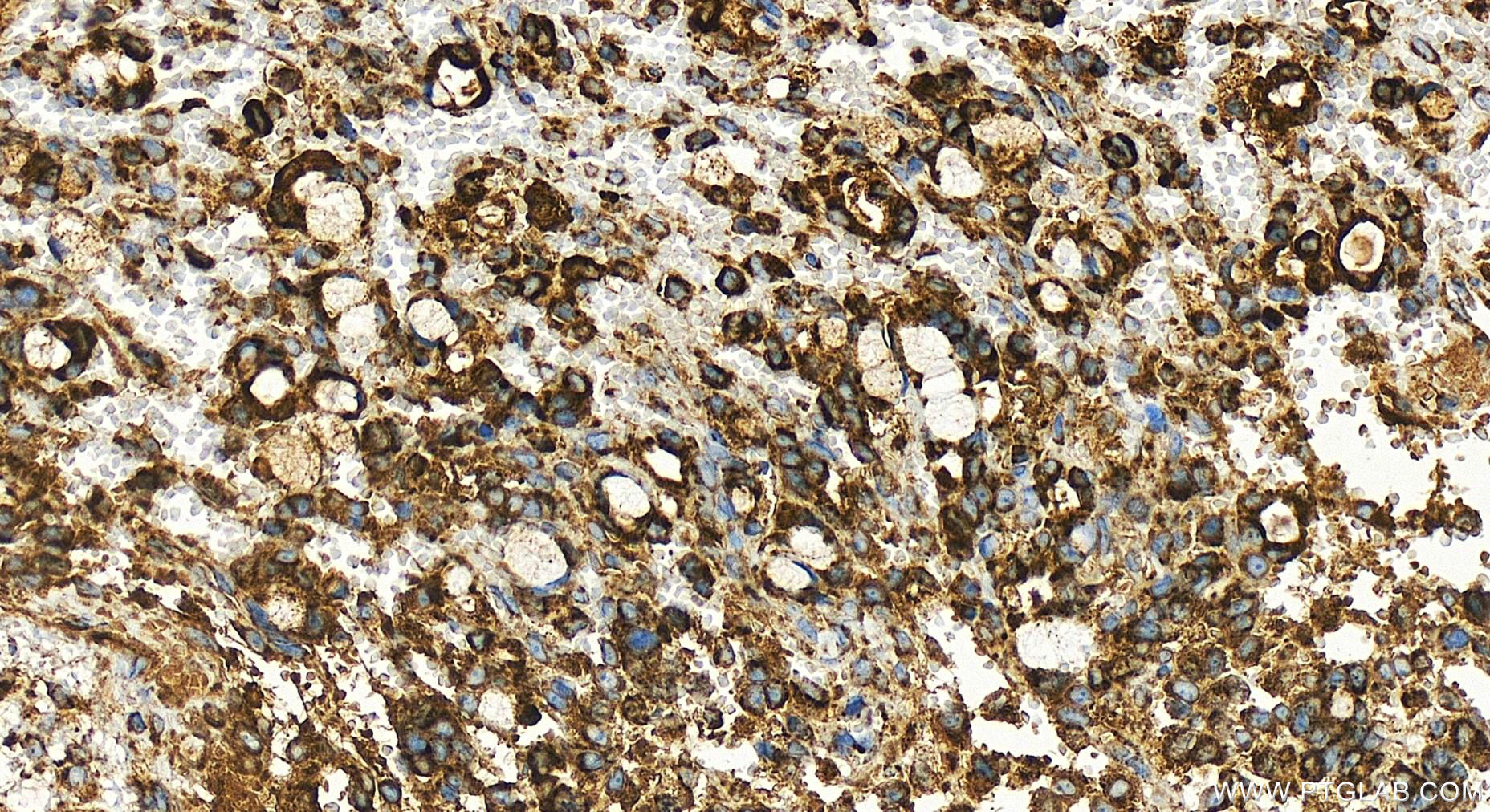 Immunohistochemistry (IHC) staining of human ovary cancer tissue using SOD2 Recombinant antibody (83519-3-RR)