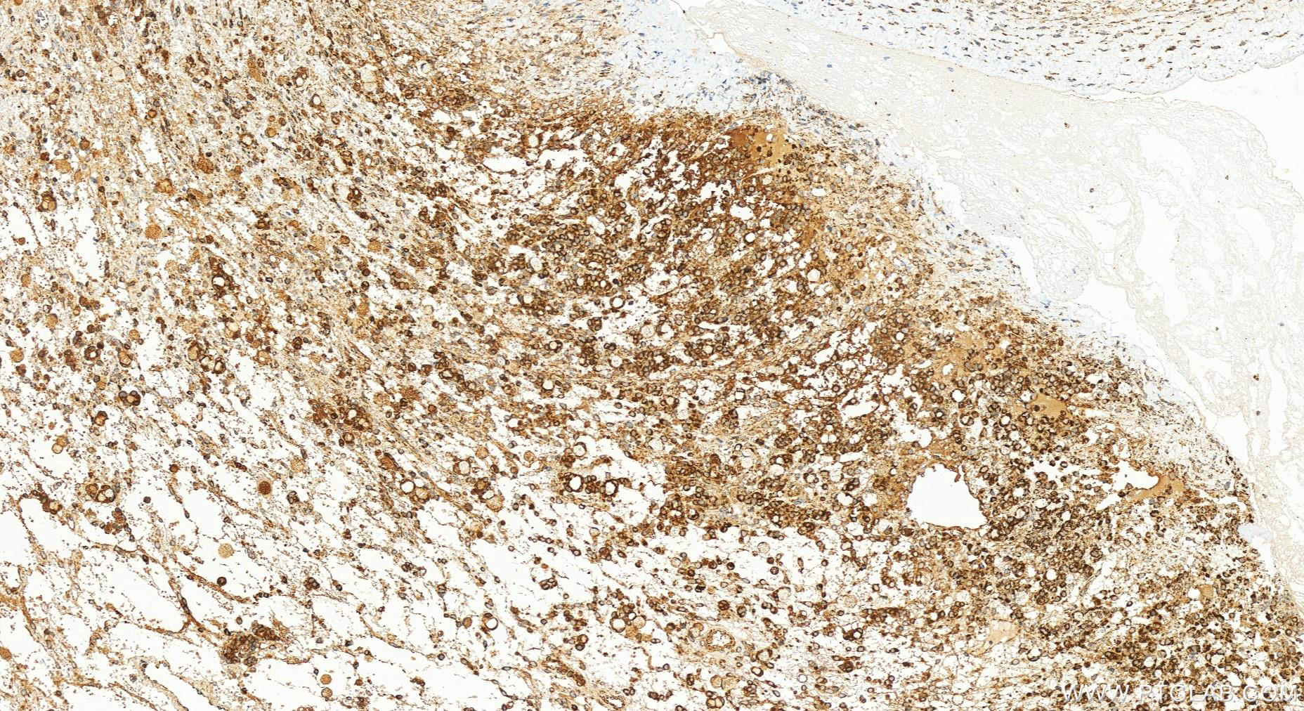 Immunohistochemistry (IHC) staining of human ovary cancer tissue using SOD2 Recombinant antibody (83519-4-RR)