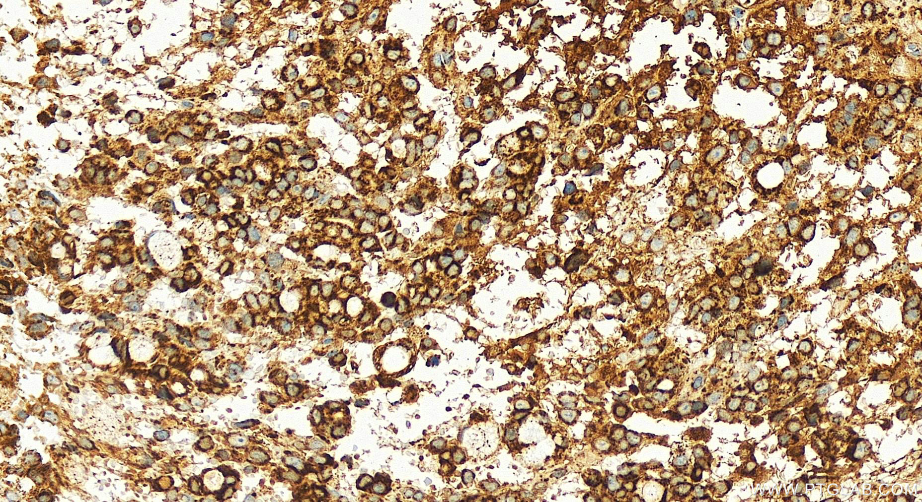 Immunohistochemistry (IHC) staining of human ovary cancer tissue using SOD2 Recombinant antibody (83519-4-RR)