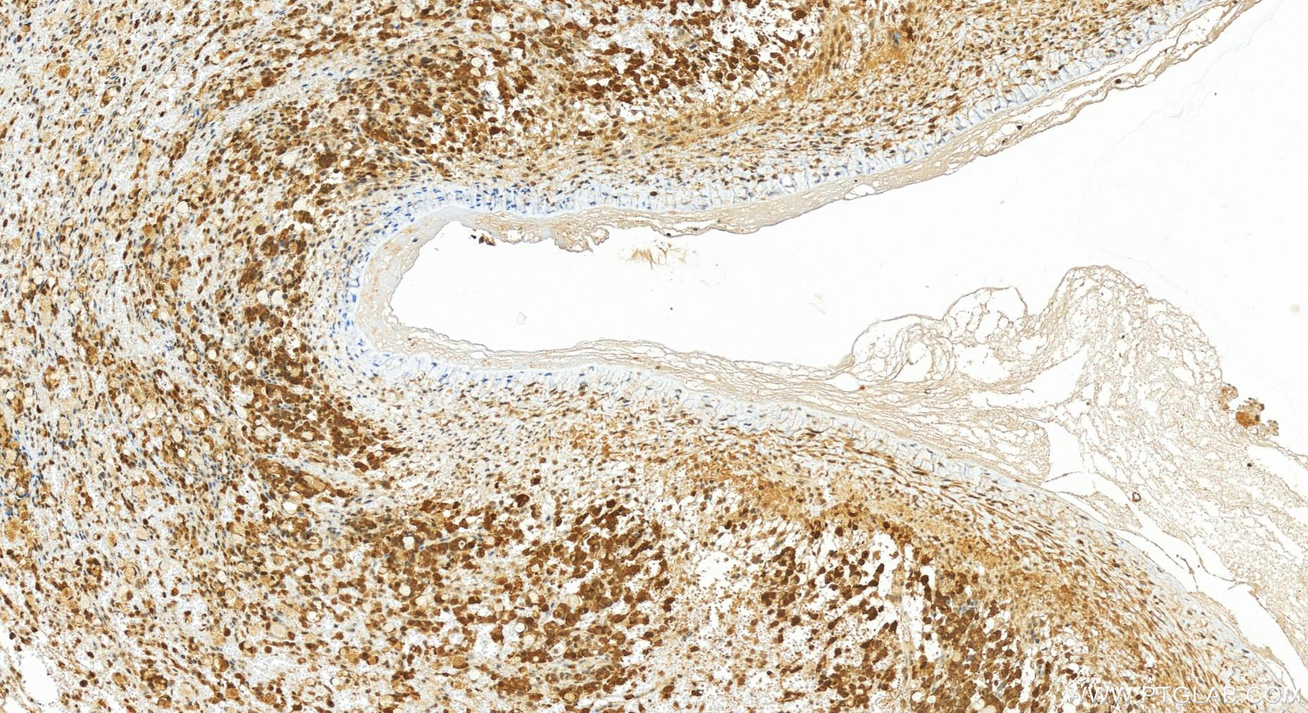 Immunohistochemistry (IHC) staining of human ovary cancer tissue using Sorbitol dehydrogenase Polyclonal antibody (15881-1-AP)