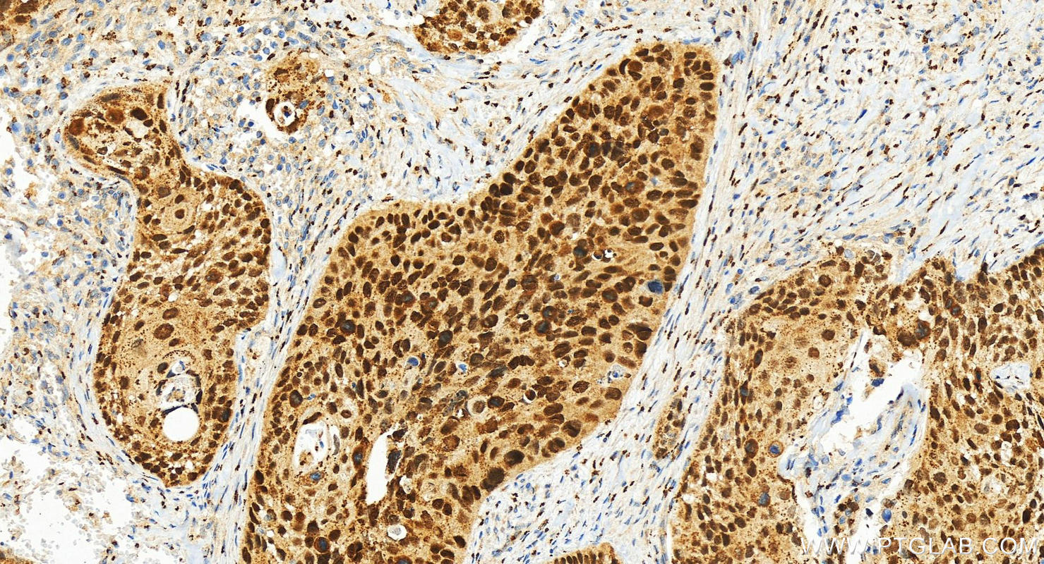 Immunohistochemistry (IHC) staining of human cervical squamous cancer tissue using SOX2 Polyclonal antibody (11064-1-AP)