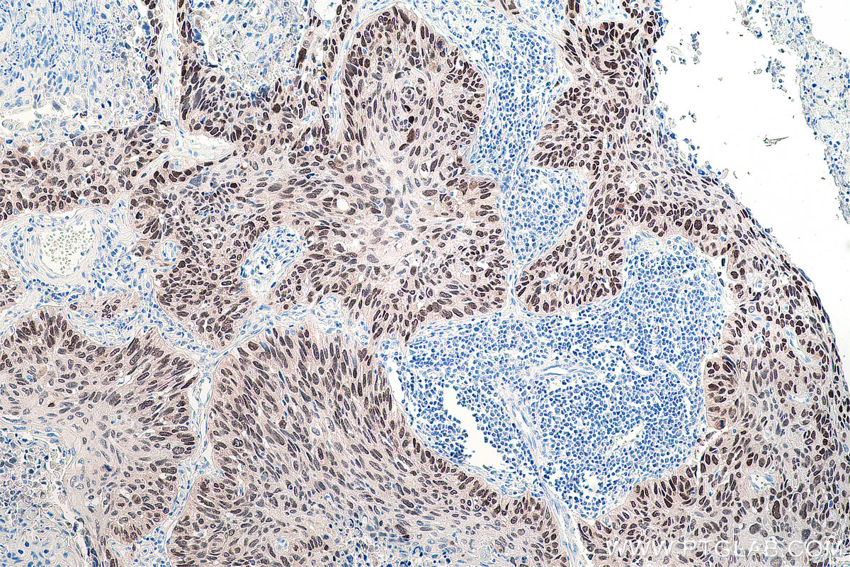 Immunohistochemistry (IHC) staining of human lung cancer tissue using SOX2 Monoclonal antibody (66411-1-Ig)