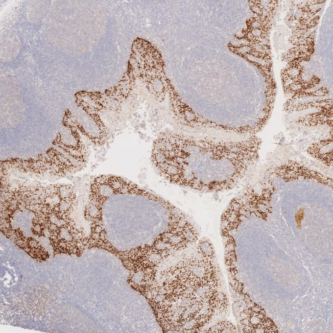 Immunohistochemistry (IHC) staining of human tonsillitis tissue using SOX2 Monoclonal antibody (66411-1-Ig)