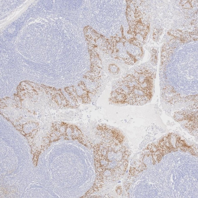 Immunohistochemistry (IHC) staining of human tonsillitis tissue using SOX2 Monoclonal antibody (66411-1-Ig)