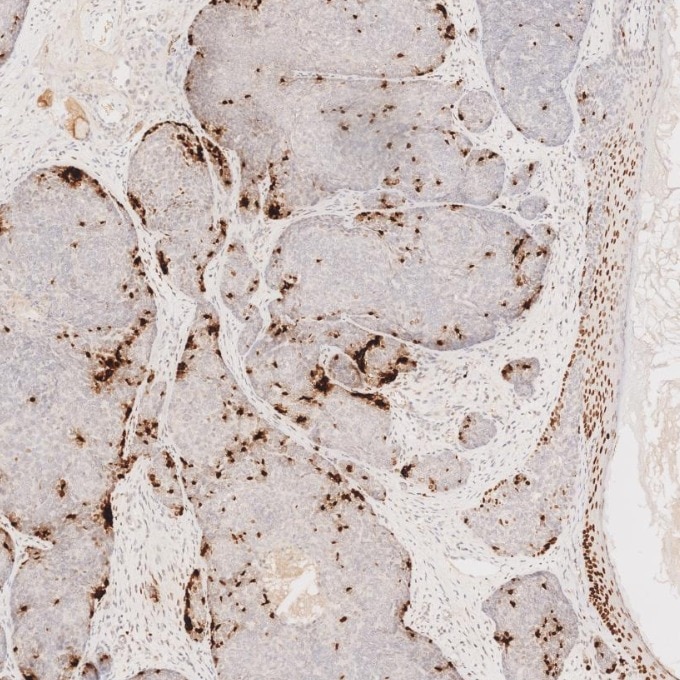 Immunohistochemistry (IHC) staining of human skin cancer tissue using SOX2 Monoclonal antibody (66411-1-Ig)
