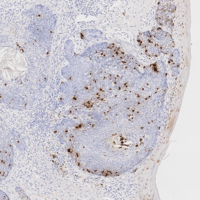 Immunohistochemistry (IHC) staining of human skin cancer tissue using SOX2 Monoclonal antibody (66411-1-Ig)