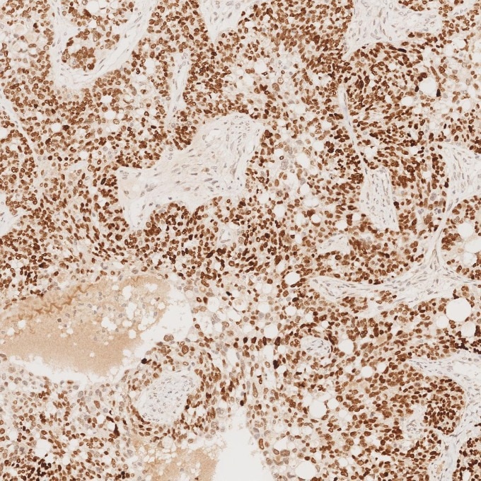 Immunohistochemistry (IHC) staining of human ovary cancer tissue using SOX2 Monoclonal antibody (66411-1-Ig)