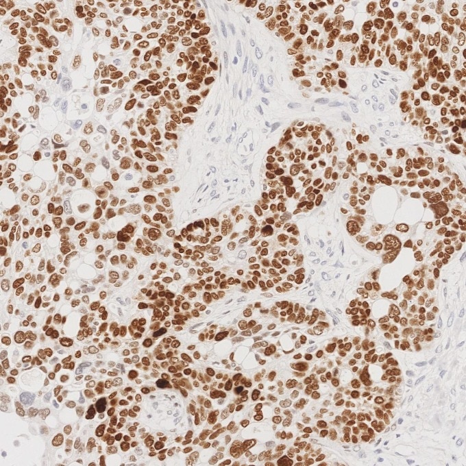 Immunohistochemistry (IHC) staining of human ovary cancer tissue using SOX2 Monoclonal antibody (66411-1-Ig)