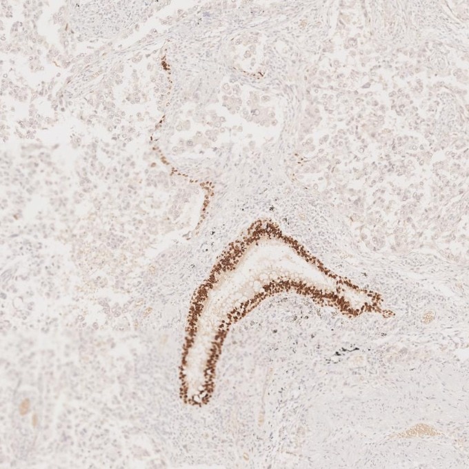 Immunohistochemistry (IHC) staining of human lung cancer tissue using SOX2 Monoclonal antibody (66411-1-Ig)