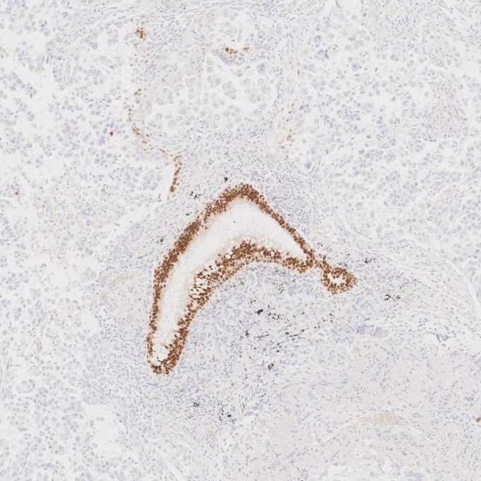Immunohistochemistry (IHC) staining of human lung cancer tissue using SOX2 Monoclonal antibody (66411-1-Ig)