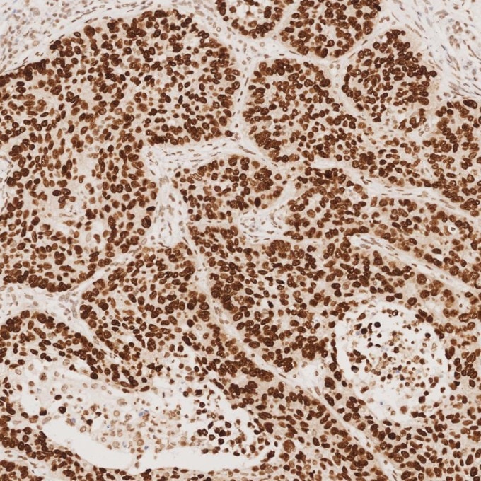 Immunohistochemistry (IHC) staining of human lung cancer tissue using SOX2 Monoclonal antibody (66411-1-Ig)