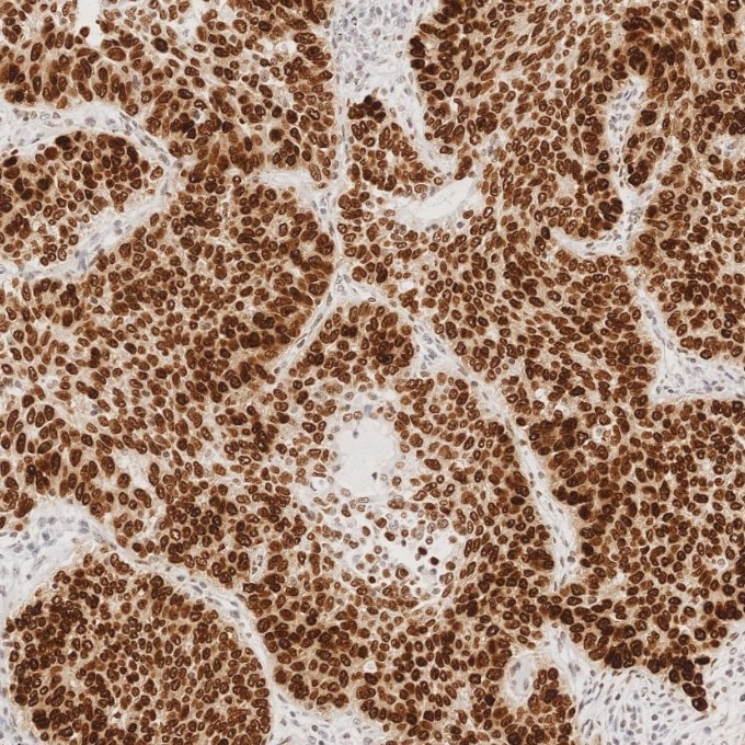 Immunohistochemistry (IHC) staining of human lung cancer tissue using SOX2 Monoclonal antibody (66411-1-Ig)