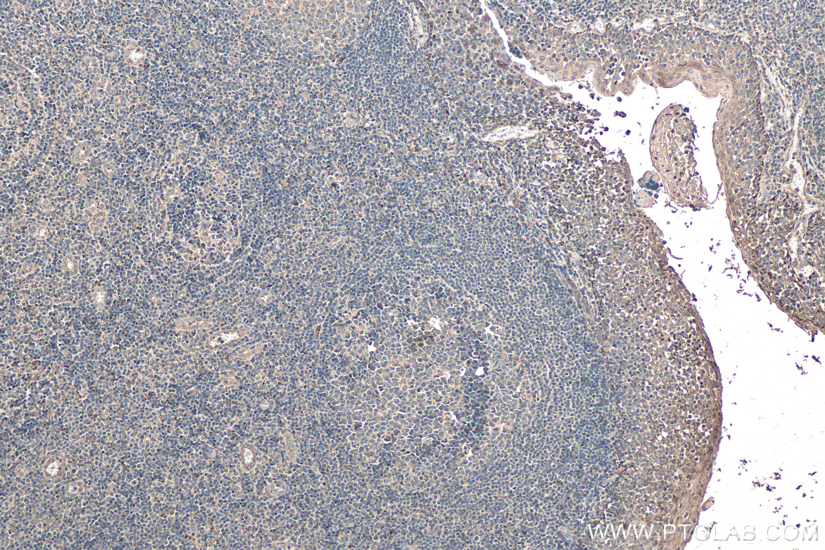 Immunohistochemistry (IHC) staining of human tonsillitis tissue using SOX9 Monoclonal antibody (67439-1-Ig)