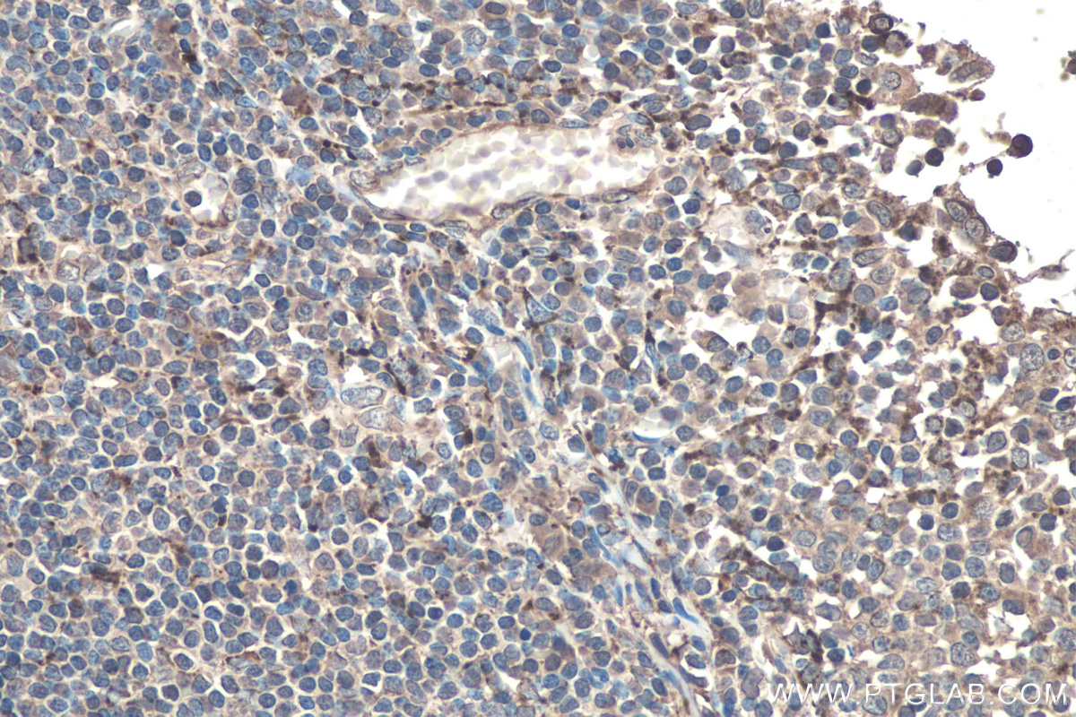 Immunohistochemistry (IHC) staining of human tonsillitis tissue using SOX9 Monoclonal antibody (67439-1-Ig)