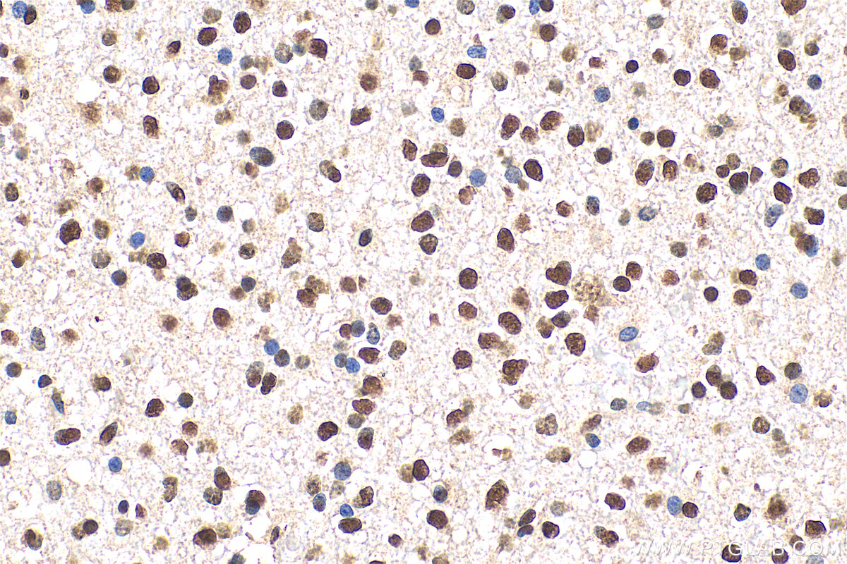 Immunohistochemistry (IHC) staining of human gliomas tissue using SOX9 Monoclonal antibody (67439-1-Ig)