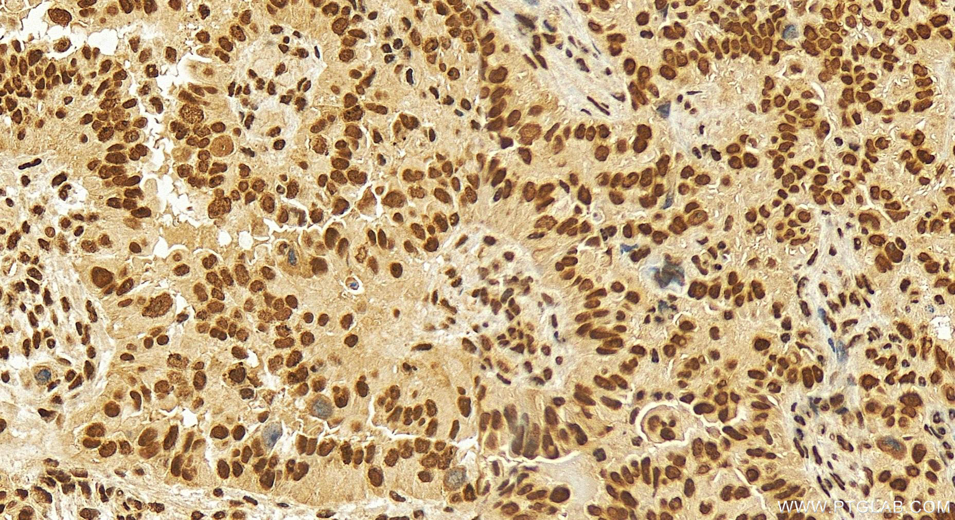 Immunohistochemistry (IHC) staining of human ovary cancer tissue using SP3 Polyclonal antibody (26584-1-AP)