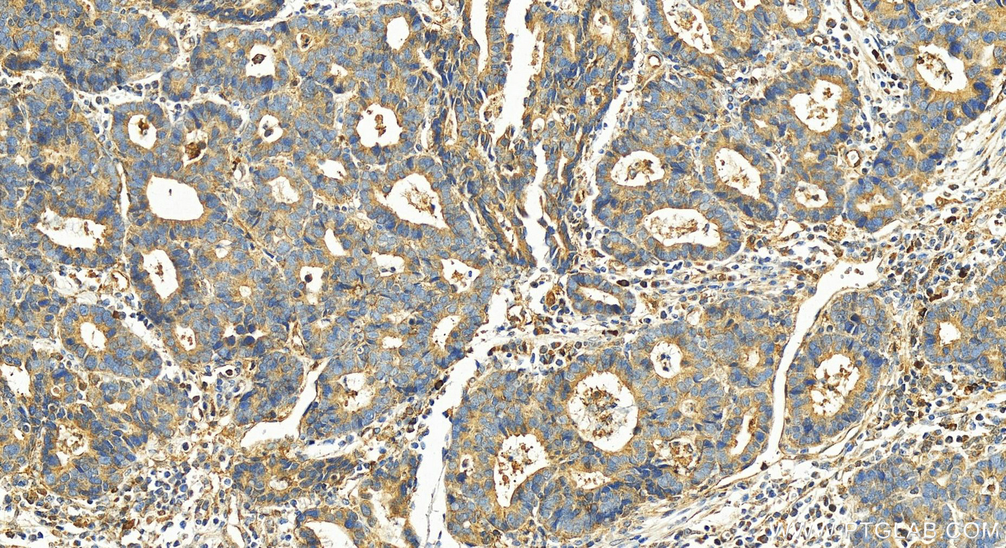 Immunohistochemistry (IHC) staining of human stomach cancer tissue using SP6 Polyclonal antibody (28561-1-AP)