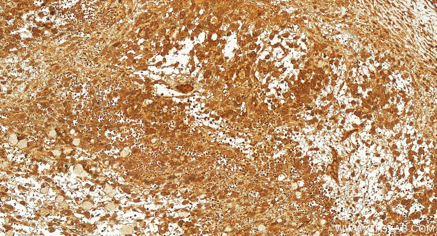 Immunohistochemistry (IHC) staining of human ovary cancer tissue using SPAST Polyclonal antibody (22792-1-AP)